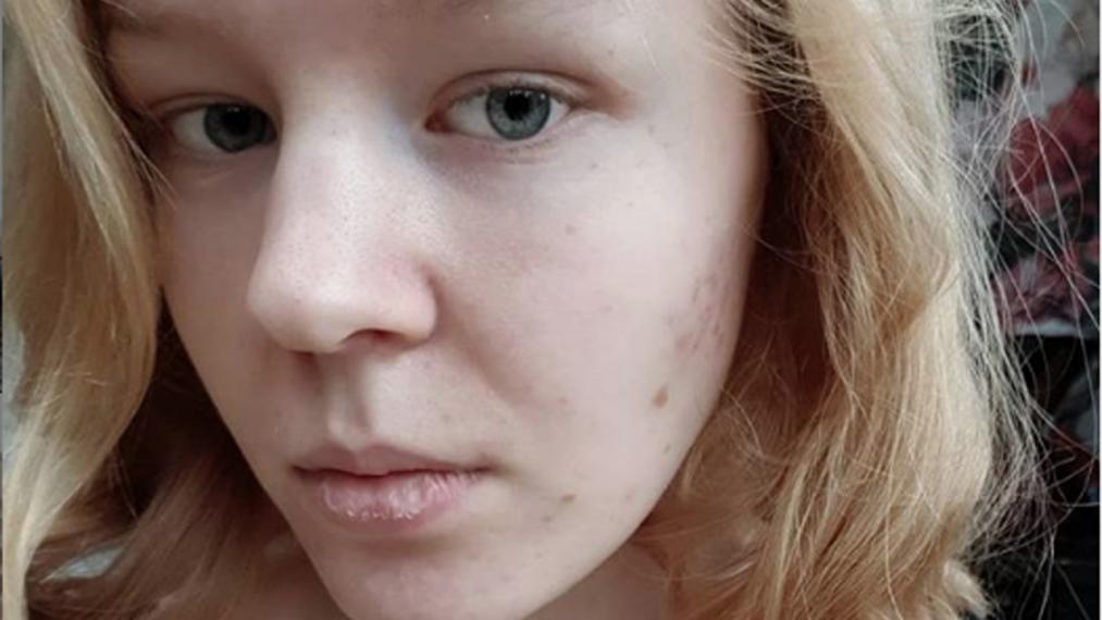 Nuk i mbijeton dot traumës, 17-vjeçarja holandeze zgjedh eutanazinë