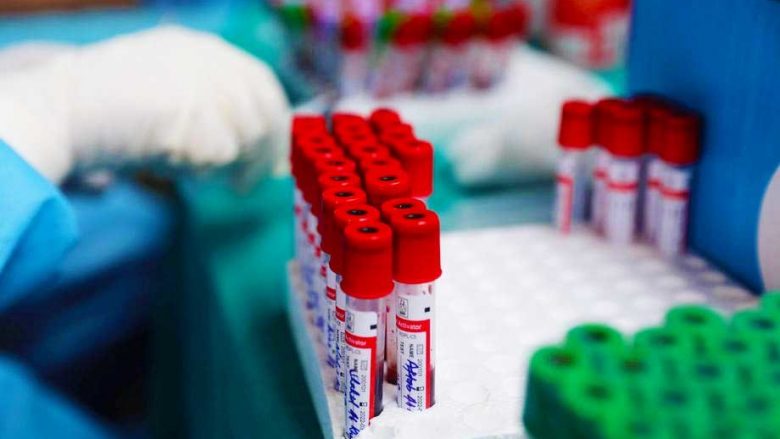 Dy viktima dhe 145 raste të reja me COVID-19 në Maqedoninë e Veriut