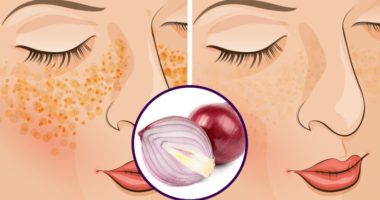 Hiqni njollat e fytyrës, duke përdorur vetëm qepë!