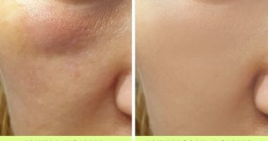 Pse nuk duhet të përdorni peshqir për të fshirë fytyrën