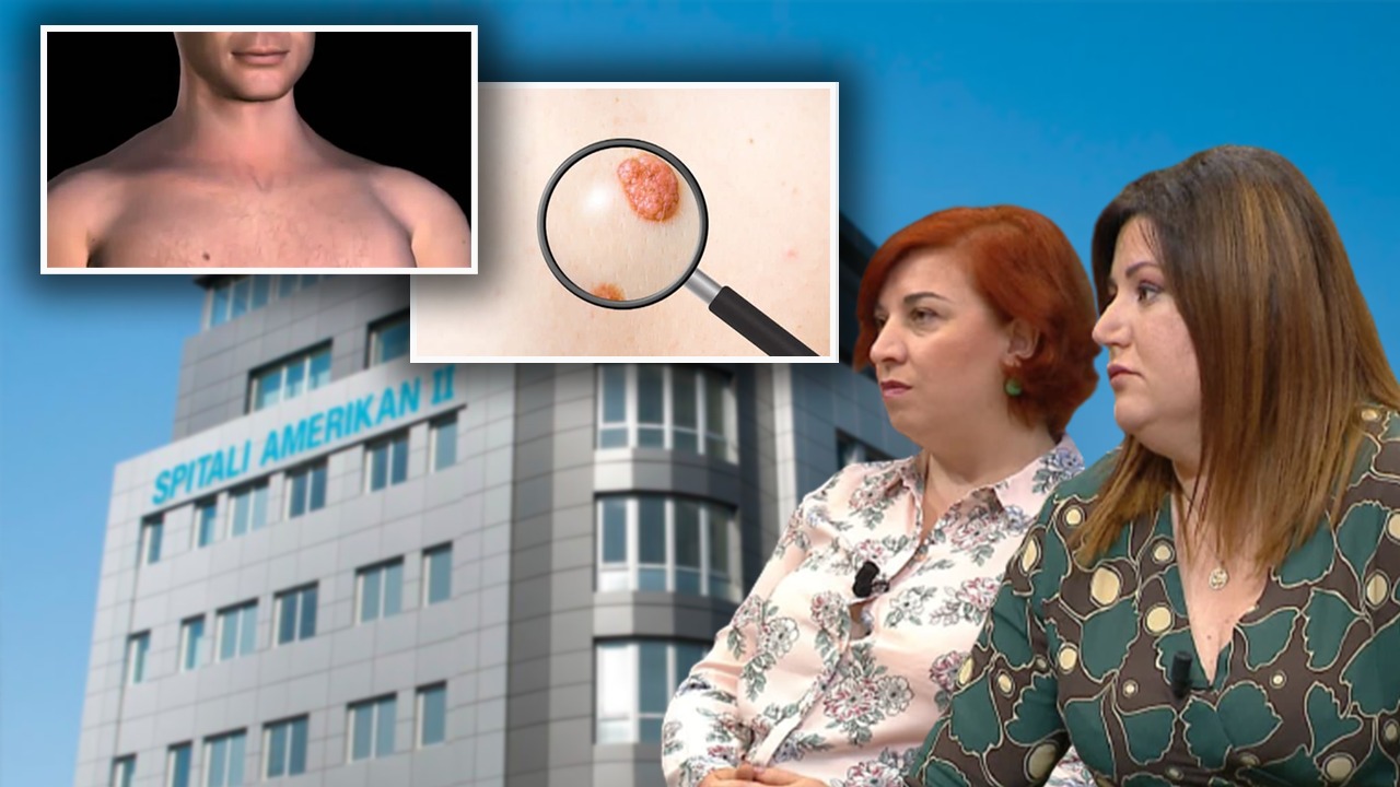 Melanomat, diagnostikimi dhe rreziqet, mjeket tregojnë çfarë duhet të kemi kujdes