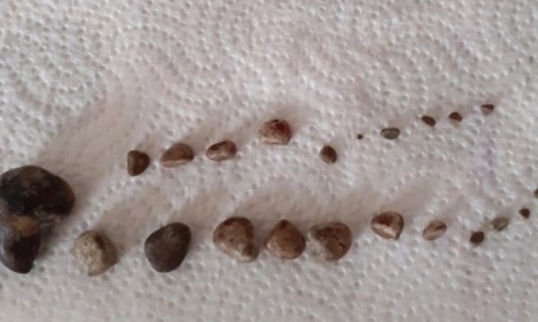 “Kam dhimbje të madhe”, pacientit në Kosovë i hiqen mbi  20 gurë nga veshkat