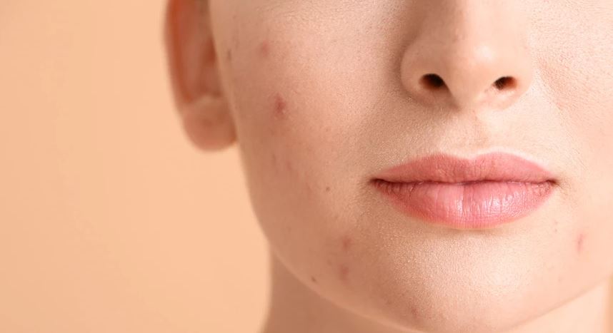 48% e europianëve kanë të paktën një problem dermatologjik, cili është më i zakonshmi