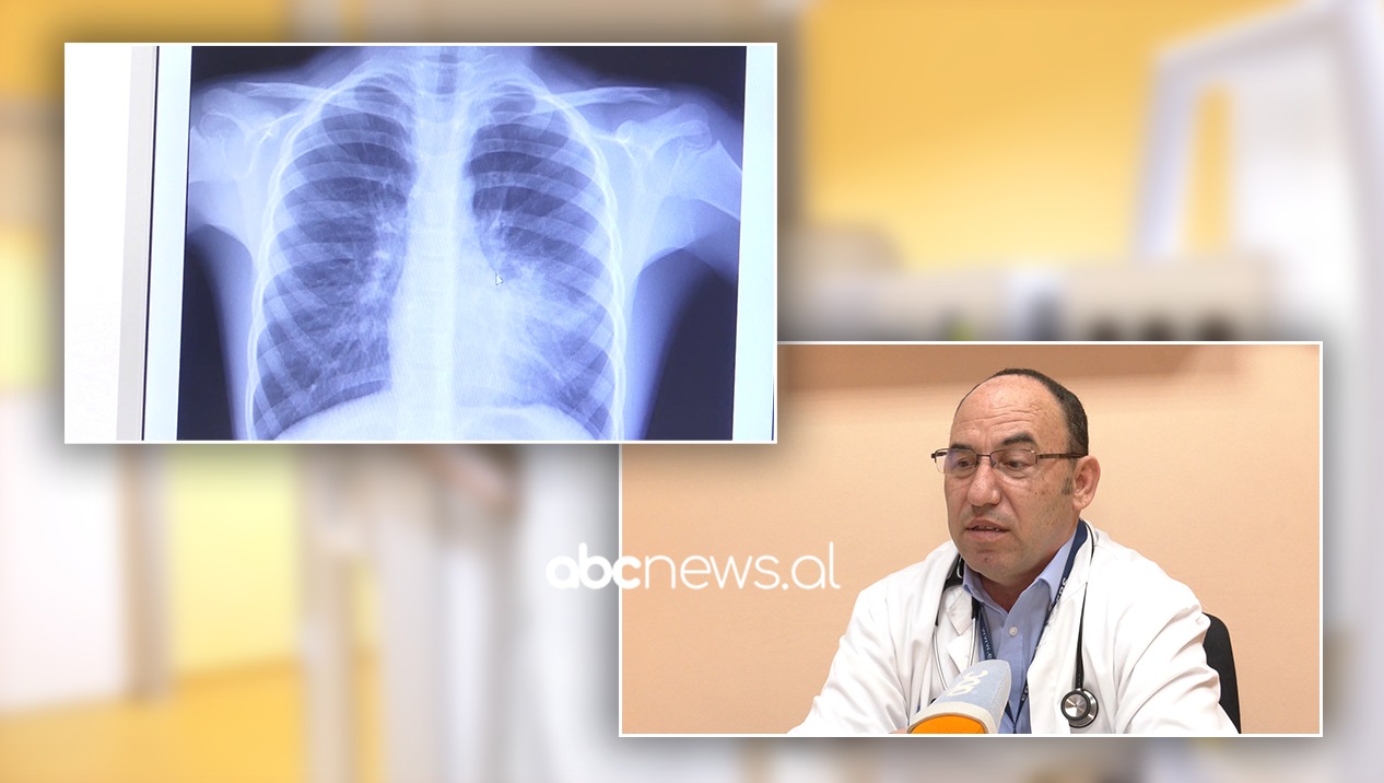 Hipertensioni pulmonar prek 1% të popullsisë, mjekët: Fatal nëse nuk trajtohet