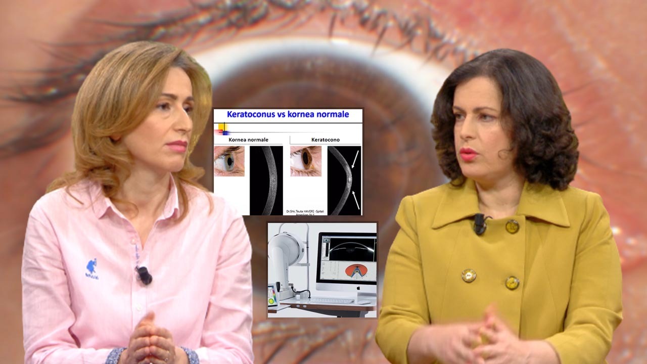 “Keratokonus”, sëmundja e syve tek të rinjtë, mjeket shpjegojnë kurimin me teknologjinë e fundit