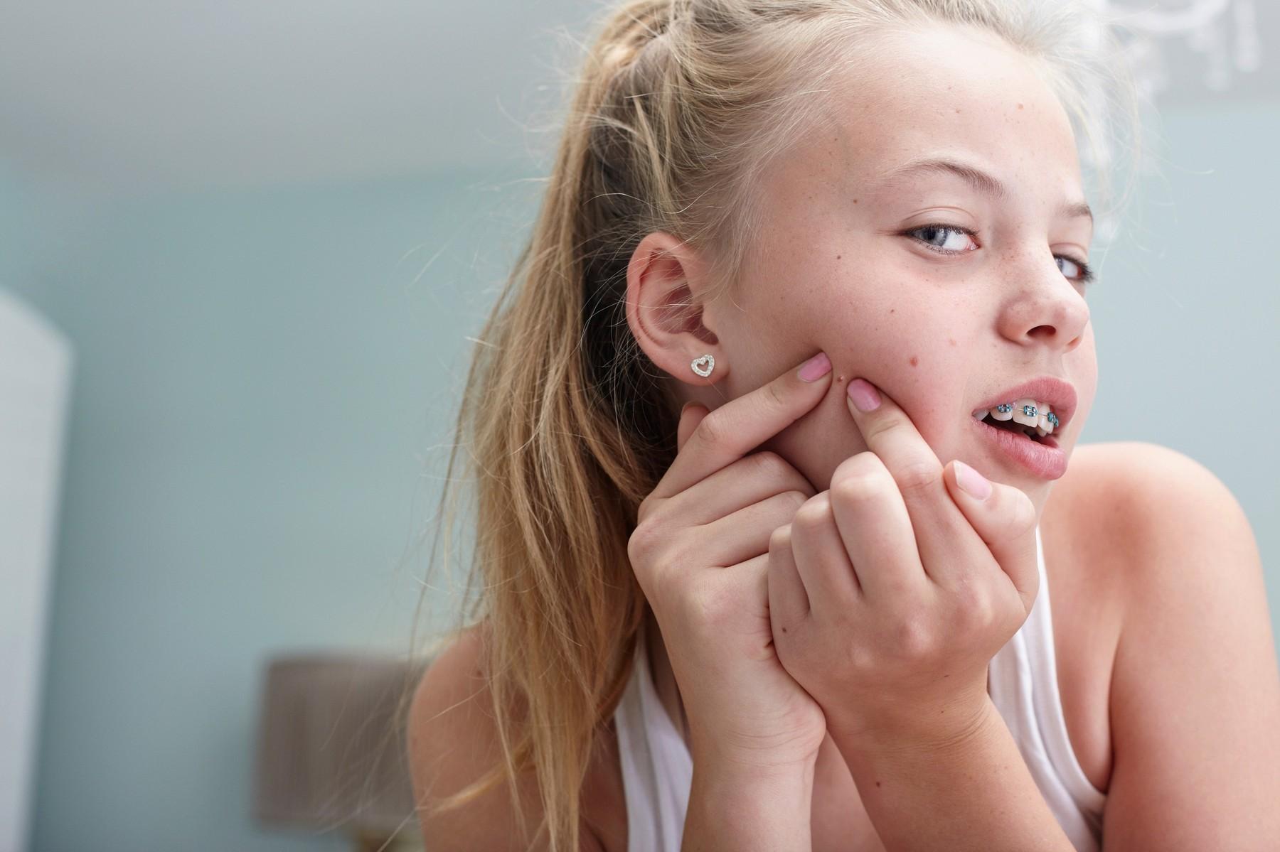Dermatologët paralajmërojnë: Mos i shtrydhni kurrë puçrrat në këtë pjesë të fytyrës