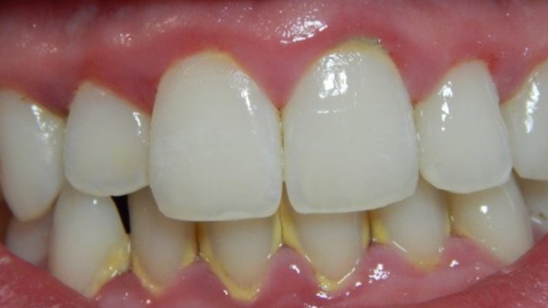 Pllaka infeksionale në dhëmbë? Mënyrat natyrale për t’i larguar në një kohë të shkurtër