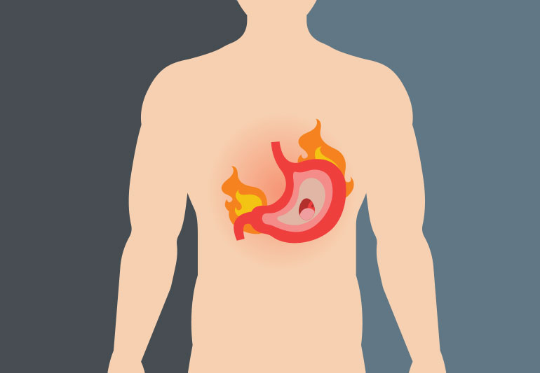 Djegie stomaku? Çfarë duhet të dini mbi gastritin