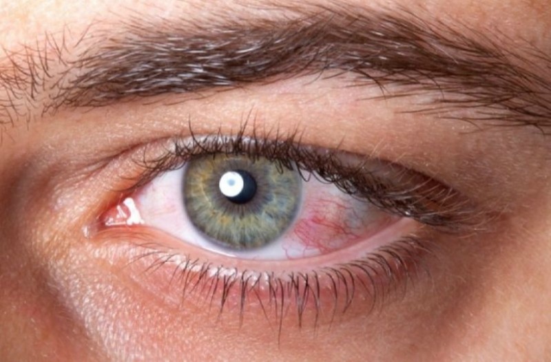 Çfarë e shkakton skuqjen e syrit? Si të veproni në raste të tilla
