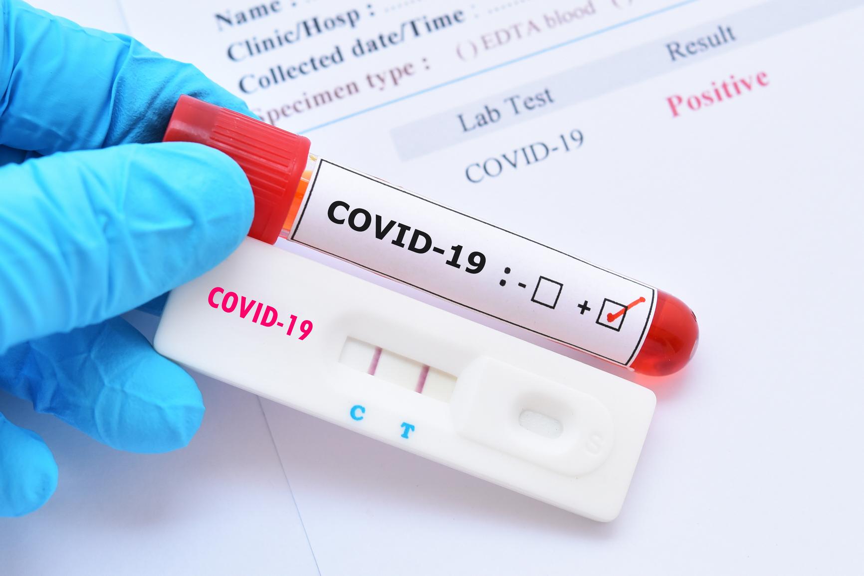 Asnjë humbje jete dhe 13 raste të reja me COVID-19 në 24 orët e fundit