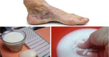 Luftoni variçet dhe trombozën në mënyrë efektive me vetëm dy përbërës