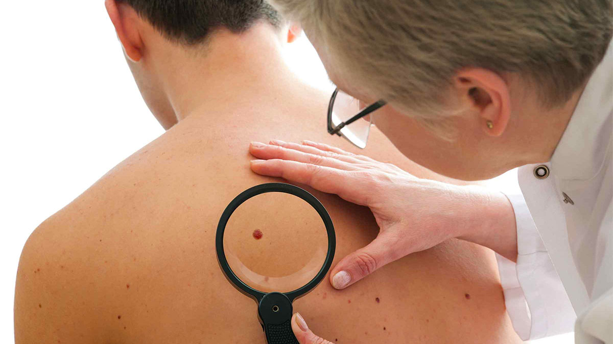 Melanoma, si të dalloni dhe parandaloni në kohë kancerin e lëkurës