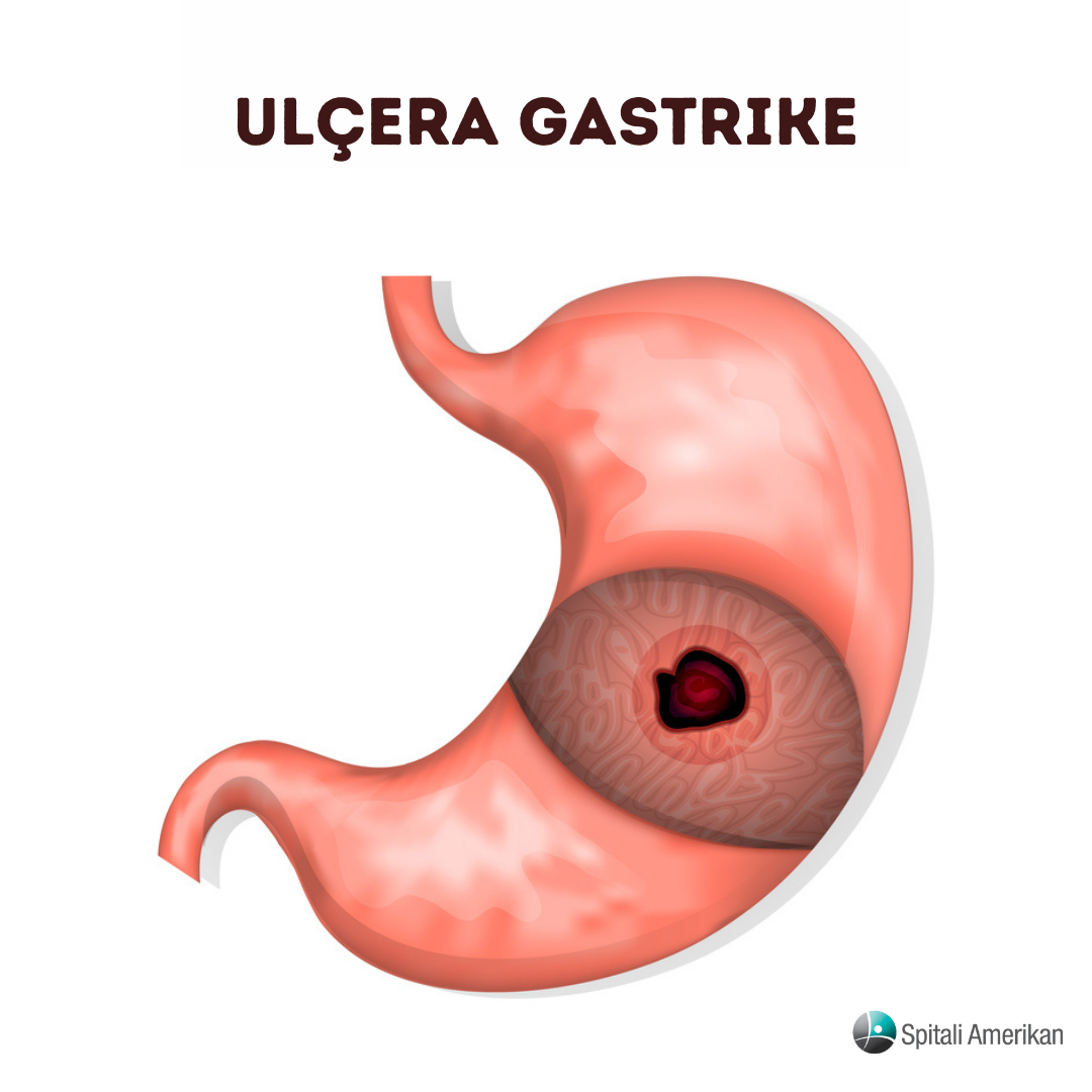 Ulçëra gastrike, shkaqet dhe kura