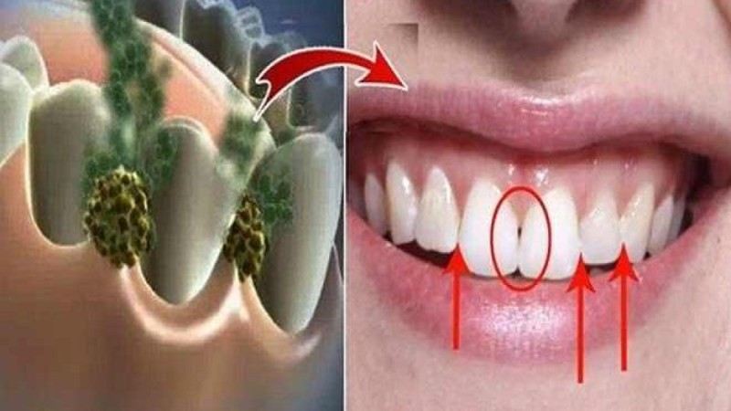 Eliminoni aromën e keqe të gojës brenda 5 minutave, ilaçi shtëpiak që vret të gjitha bakteret