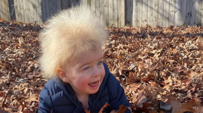 Fëmija viral me flokë të elektrizuar, sindroma e rrallë që e kanë vetëm 100 njerëz në botë
