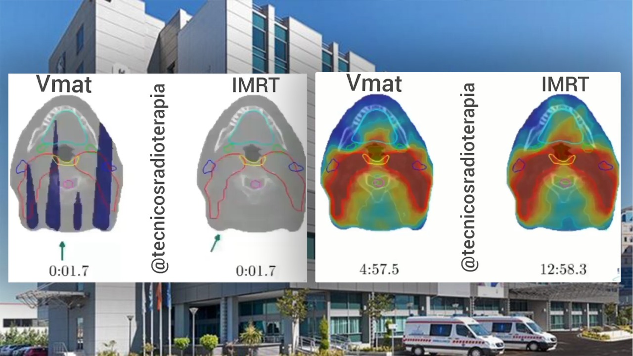 Radioterapia në Spitalin Hygeia, teknika bashkëkohore VMAT dhe avantazhet që ofron në luftën kundër kancerit krahasuar me teknikën IMRT