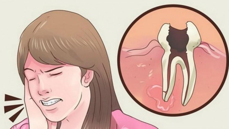 Sekreti me kanellën që do t’ju çlirojë nga dhimbjet e bezdisshme të dhëmbit
