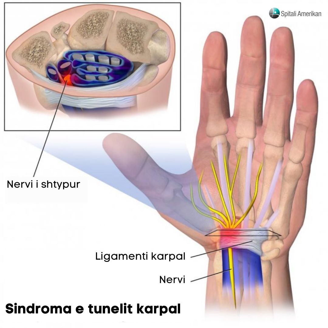 Prek dorën, çfarë është sindroma e Tunelit Karpal