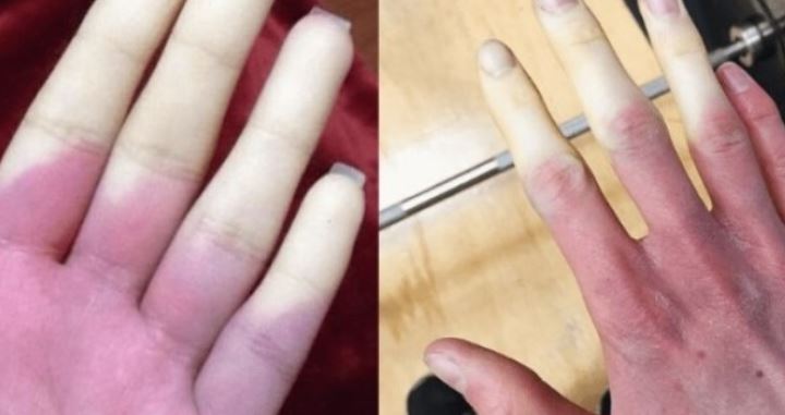 Nëse ju ndryshoi ngjyra e gishtave gjatë të ftohtit, urgjent tek mjeku
