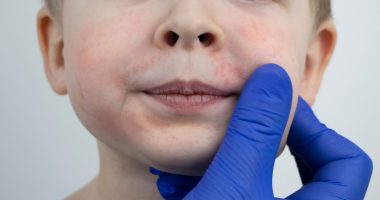 Alergjia nga kikirikët, simptomat dhe trajtimi