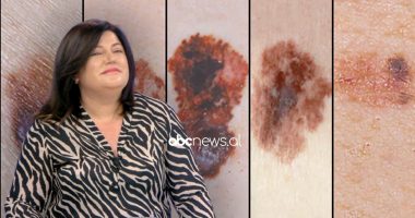 Pishinat, solarët, lazeri dhe produktet online, sa të rrezikshme janë për lëkurën? Këshilla  nga dermatologia
