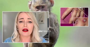 Lija e majmunëve, Dollenberg në Abc Live zbulon lidhjen e virusit me Covid-19: 10% e rasteve janë të rënda