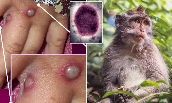 Lija e majmunëve, OBSH: Transmetimi i virusit mund të ndalet
