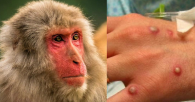 Lija e majmunëve, raportohen mbi 1000 raste në 29 vende