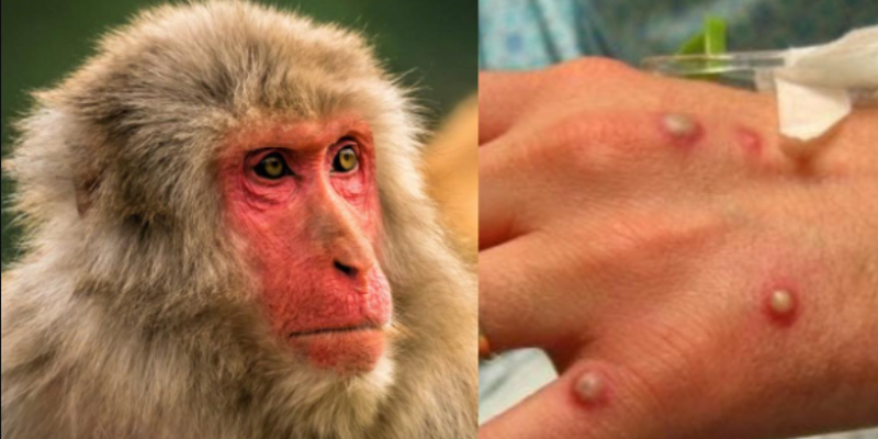 Lija e majmunëve, raportohen mbi 1000 raste në 29 vende