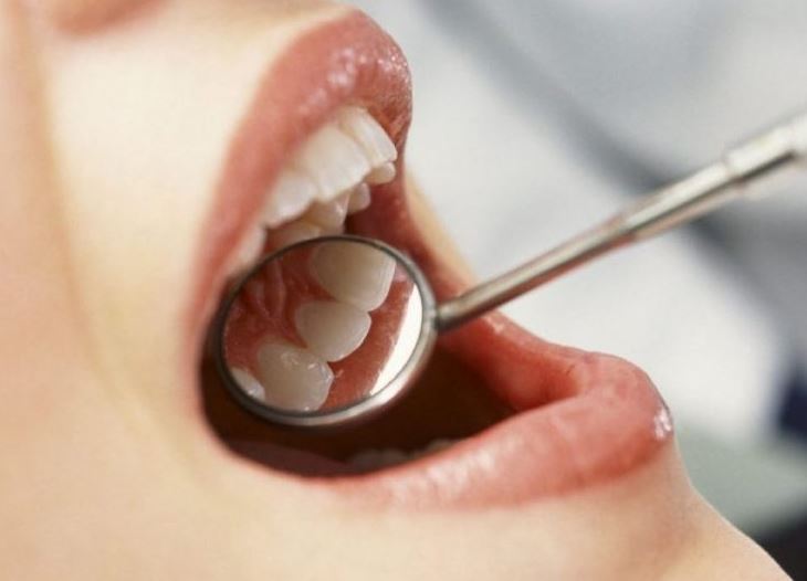 Lamtumirë dentist! Si të pastroni gurëzat në kushte shtëpie