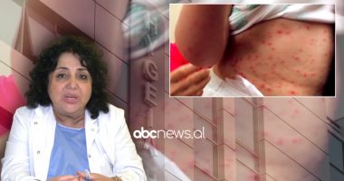 Lia e dhenve po shkakton komplikacione te fëmijet, mjekja Kuli: Kur duhet t’i drejtoheni spitalit