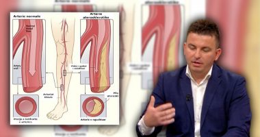 Arteriet e këmbëve, Dr. Alban Malaj tregon kur duhet të shqetësoheni: Ky është shkaktari kryesor që i dëmton