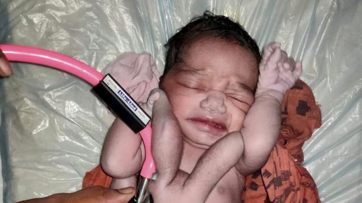 Mrekulli në Indi, foshnja lind me 4 këmbë dhe 4 duar