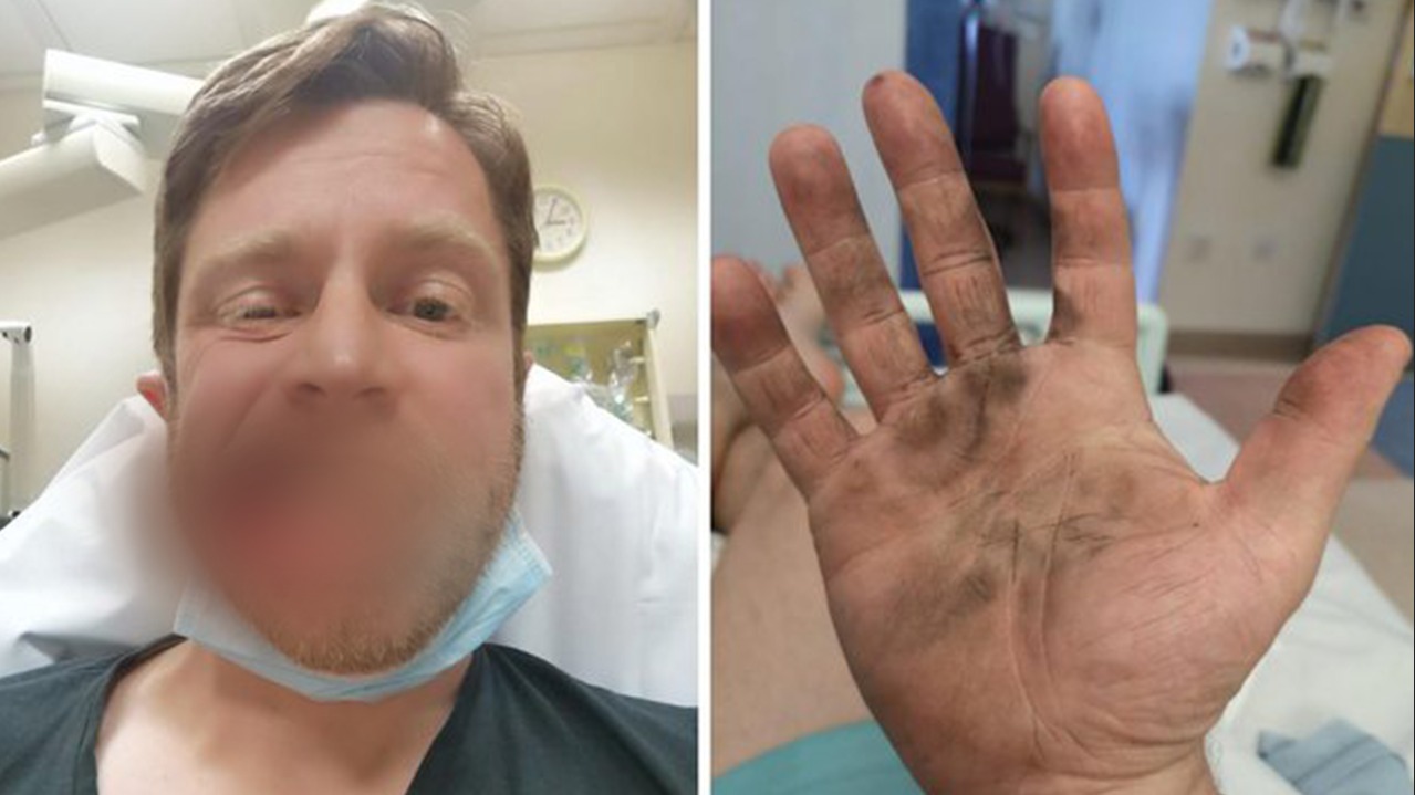 FOTO/ I shpërthen cigarja elektronike në gojë, 39-vjeçari humb 7 dhëmbë