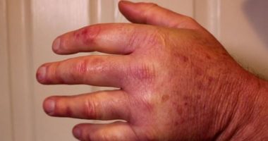 Nëse ju enjten gishtat vuani nga kjo sëmundje