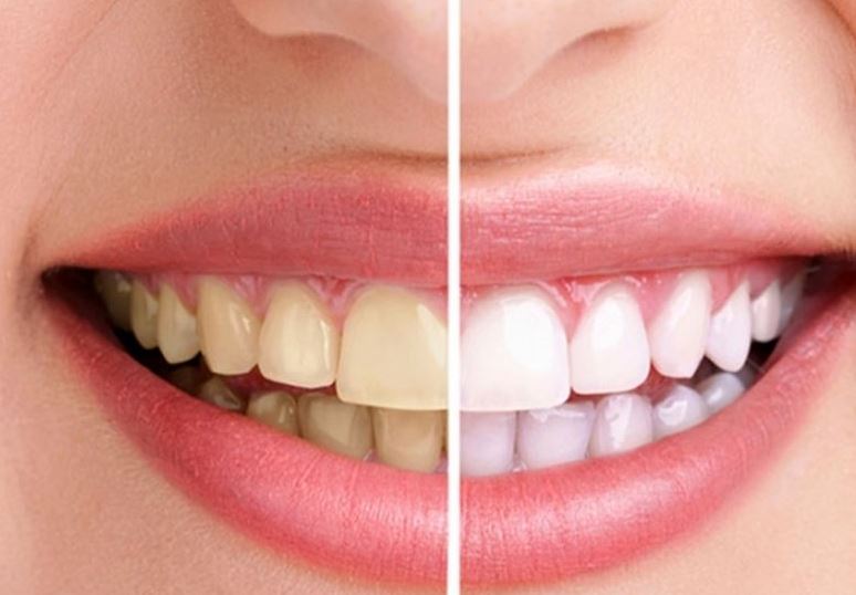 Harrojeni dentistin dhe kurseni para! Si të zbardhni dhëmbët në kushte shtëpie