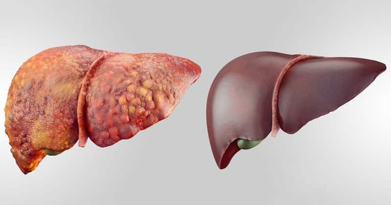 Rrezikoni vdekjen, ushqimet që shkaktojnë cirrozën e mëlçisë