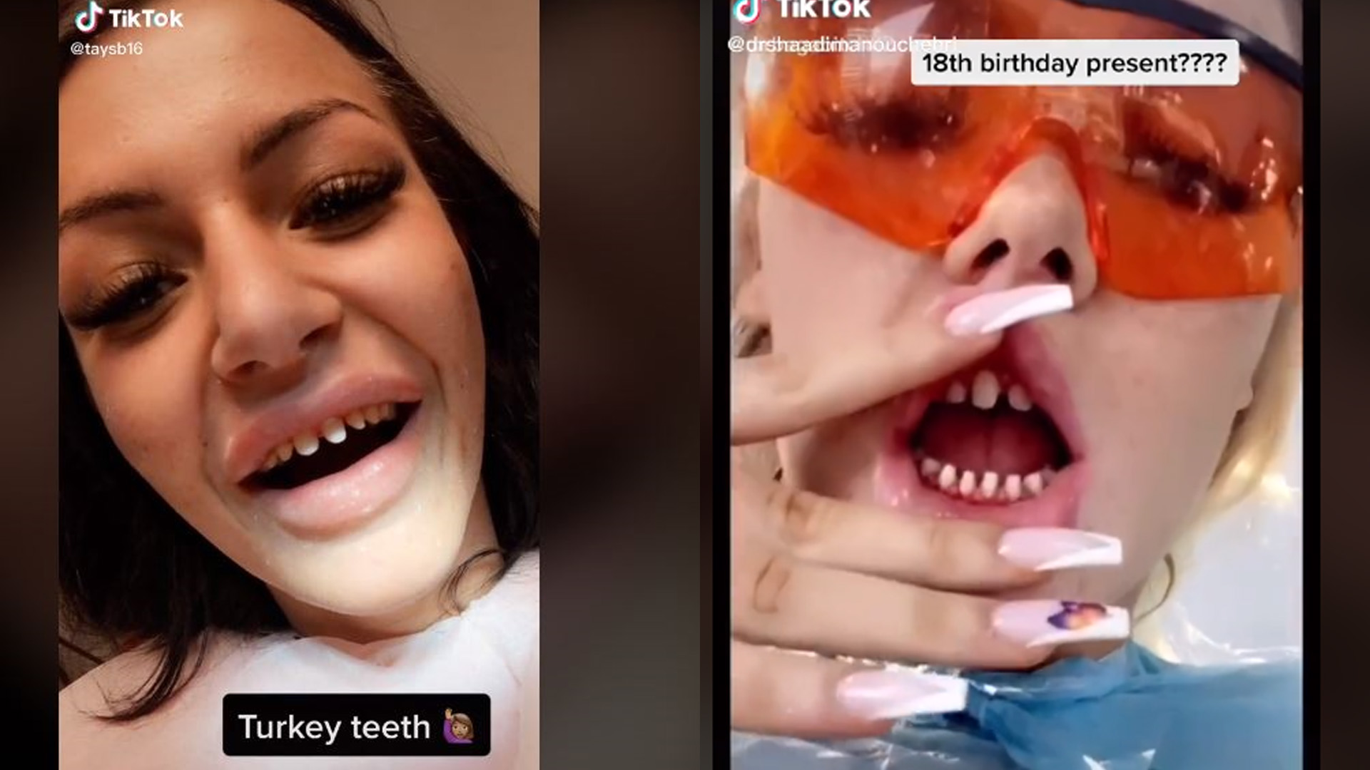 Trendi i “dhëmbëve turq” lë mijëra britanikë me pasoja serioze