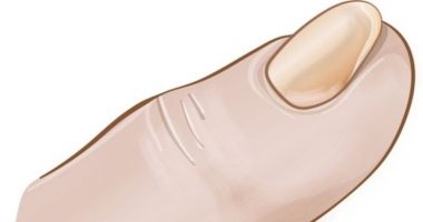 Kujdes! A janë thonjtë tuaj si “lugë”? Shenja paralajmëruese se keni këtë problem shëndetësor