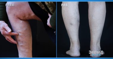 70 vjeçarja operon variçet te “Doktor Plastik” dhe lë pas edhe Kiara Titon