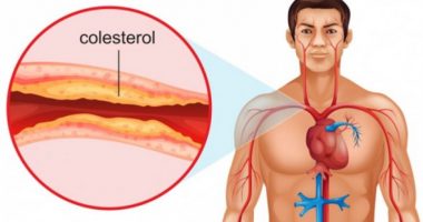 Nuk duhen neglizhuar, 7 shkaktarët e kolesterolit të lartë në gjak