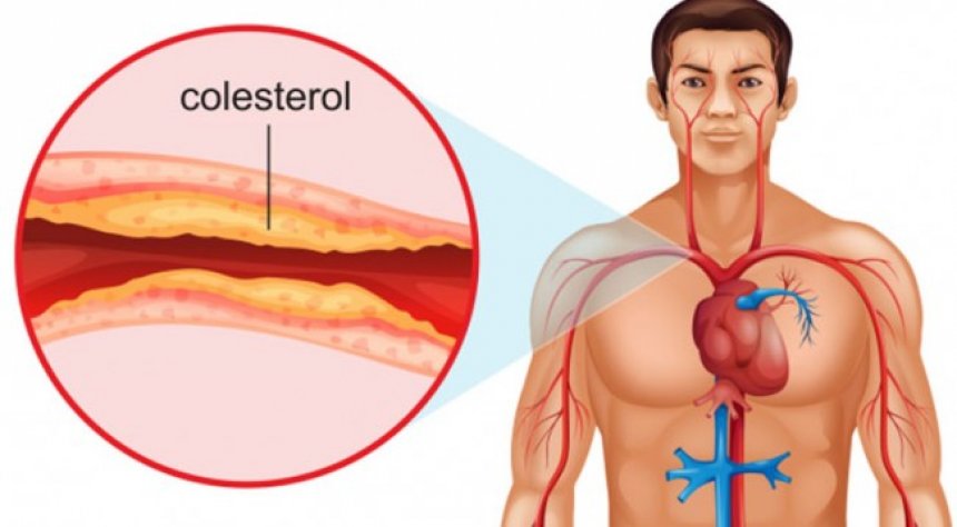 Nuk duhen neglizhuar, 7 shkaktarët e kolesterolit të lartë në gjak