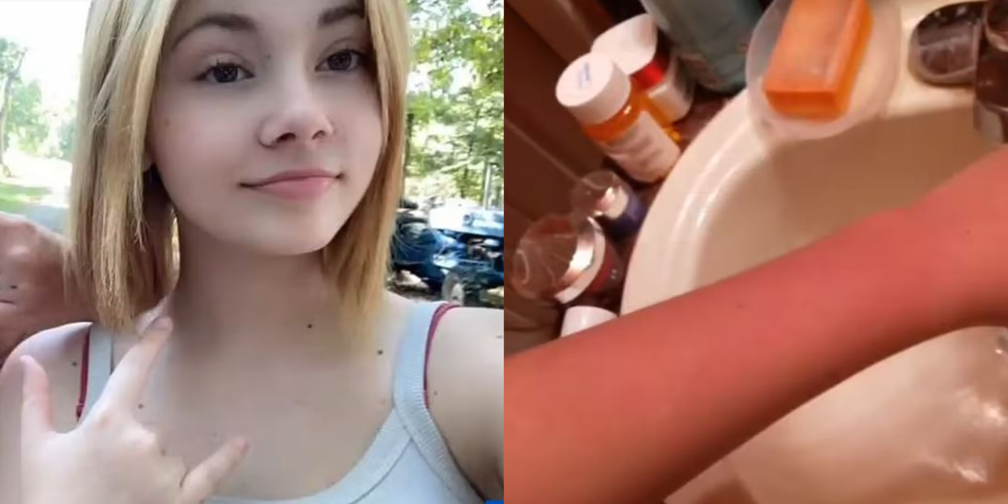 “Ndjej sikur më vihet flaka kur lahem apo qaj”, adoleshentja vuan nga alergjia ndaj ujit