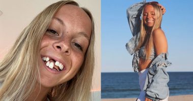 “Djemtë shokohen në takimet e para”, rrëfehet 25-vjeçarja që nuk ka 2 dhëmbë të përparmë