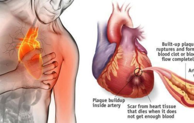 KURRË mos i neglizhoni këto shenja! 80% e vdekjeve nga sëmundjet e zemrës mund të parandalohen