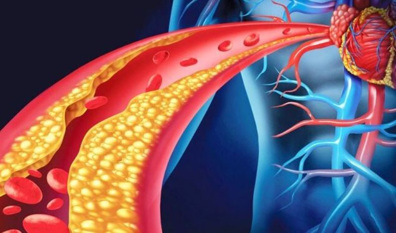 Kjo është simptoma kryesore që tregon se keni kolesterol të lartë