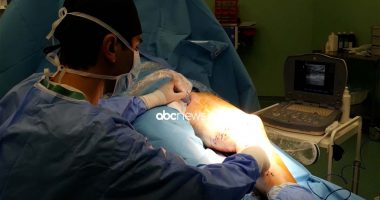 Variçet çojnë deri në trombozë: Mos neglizhoni konsultat