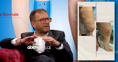 Mjeku tregon faktorët që ndikojnë në krijimin e variçeve: Estetika ka bërë që meshkujt t’i kuptojnë