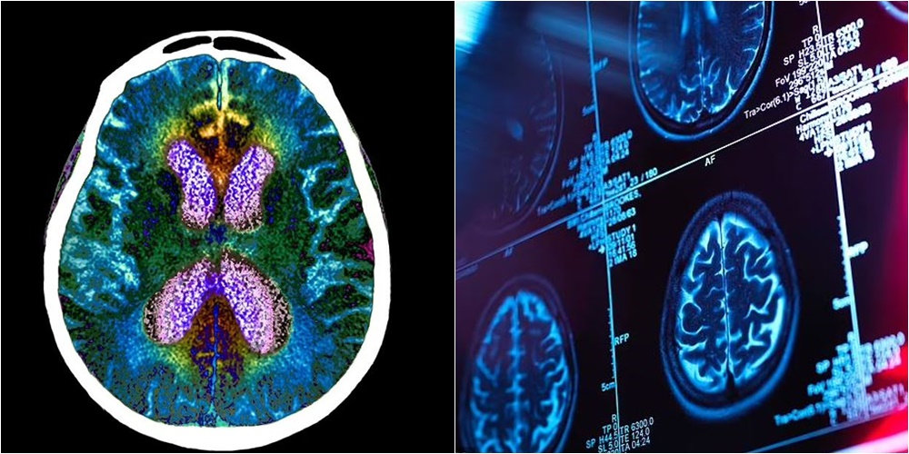 “Fillimi i fundit” të dekada viteve kërkime, rezultate premtuese nga medikamenti i ri kundër Alzheimerit