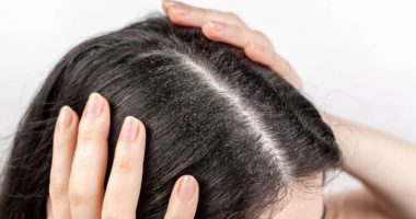 Vuani nga zbokthi, provoni këtë metodë natyrale